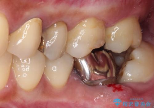 治療中放置してしまった奥歯 セラミック治療の治療前
