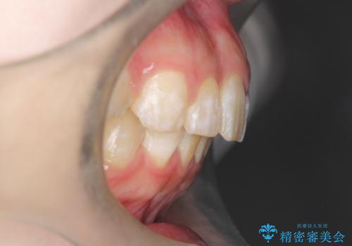 インビザラインで前歯のガタガタをきれいな歯並びへの治療後