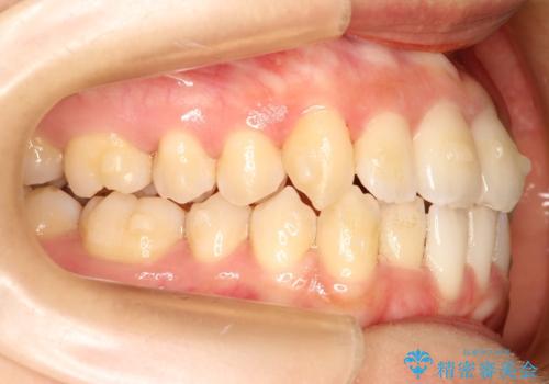 コンプレックスだった・・・唇が閉じなかった口元。綺麗になりました。の治療中