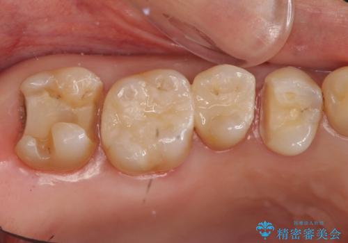 銀歯を白く　虫歯治療の治療中