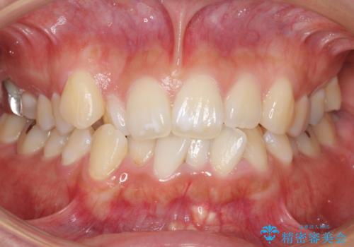 真ん中が右にずれている　前歯のがたつき　治療途中に地方へ引っ越したが、通ってワイヤー矯正の症例 治療前