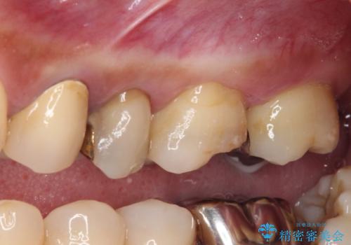 治療中放置してしまった奥歯 セラミック治療の治療前