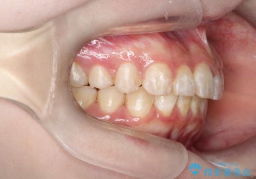 インビザラインで前歯のガタガタをきれいな歯並びへの治療後