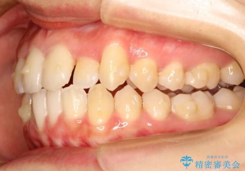 コンプレックスだった・・・唇が閉じなかった口元。綺麗になりました。の治療中