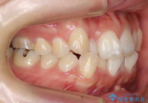 真ん中が右にずれている 前歯のがたつき 治療途中に地方へ引っ越したが、通ってワイヤー矯正の治療前