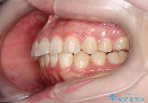 インビザラインで前歯のガタガタをきれいな歯並びへの治療後