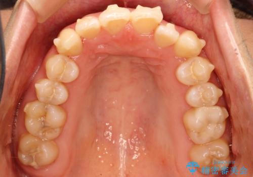 コンプレックスだった・・・唇が閉じなかった口元。綺麗になりました。の治療中