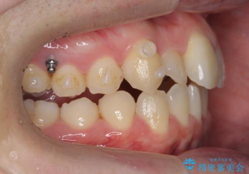 引っ込んだ前歯を並べる　歯を抜かないマウスピース矯正の治療中