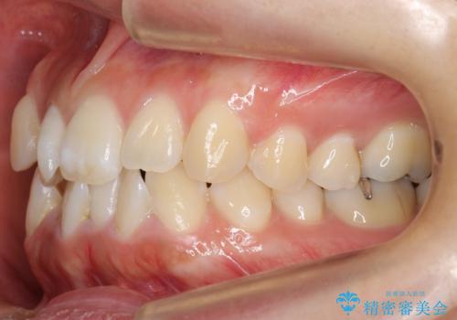 真ん中が右にずれている　前歯のがたつき　治療途中に地方へ引っ越したが、通ってワイヤー矯正の治療前