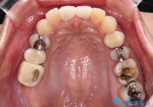 治療中放置してしまった奥歯 セラミック治療の症例 治療前