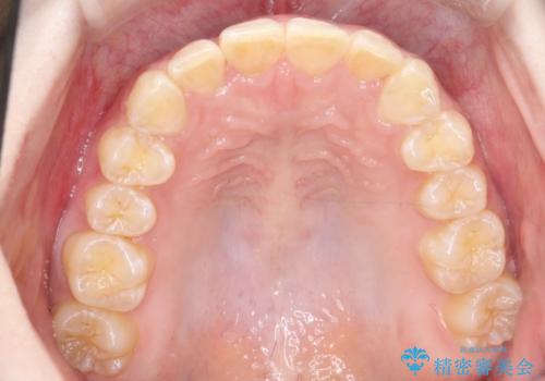 インビザラインで前歯のガタガタをきれいな歯並びへの治療後