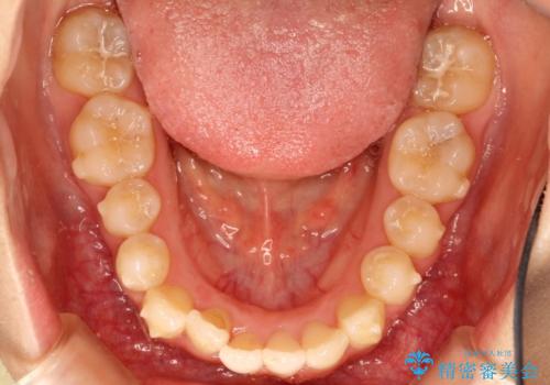 コンプレックスだった・・・唇が閉じなかった口元。綺麗になりました。の治療中