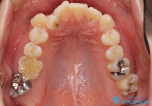 真ん中が右にずれている 前歯のがたつき 治療途中に地方へ引っ越したが、通ってワイヤー矯正の治療前