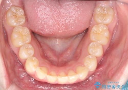 インビザラインで前歯のガタガタをきれいな歯並びへの治療後