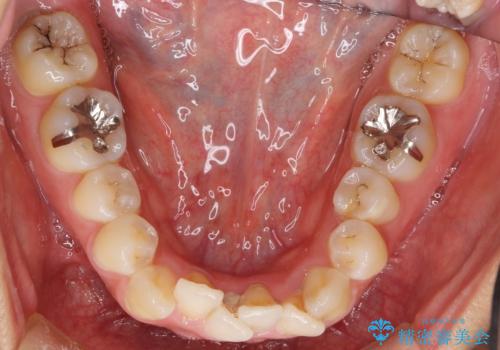 真ん中が右にずれている 前歯のがたつき 治療途中に地方へ引っ越したが、通ってワイヤー矯正の治療前