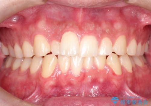 『目立たない装置で前歯のガタガタを治したい』インビザライン症例の治療前