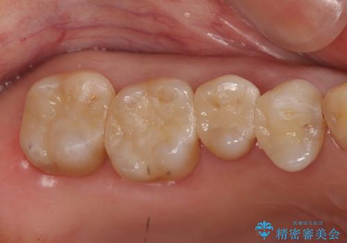 銀歯を白く　虫歯治療の症例 治療後
