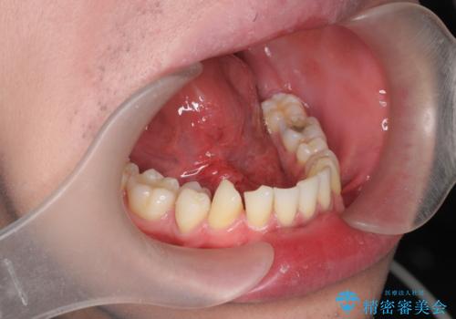 [ 舌小帯形成術 ]舌が短い 小手術での改善の症例 治療後