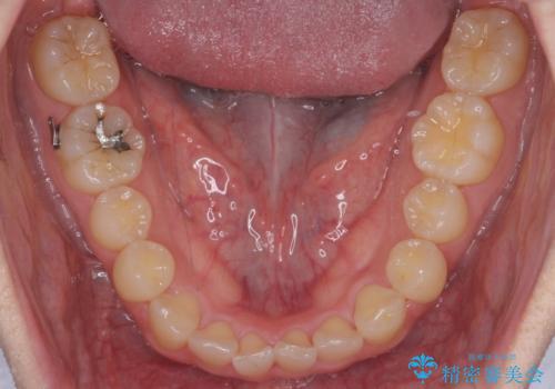 引っ込んだ前歯を並べる　歯を抜かないマウスピース矯正の治療中