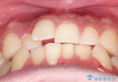 『目立たない装置で前歯のガタガタを治したい』インビザライン症例の治療前