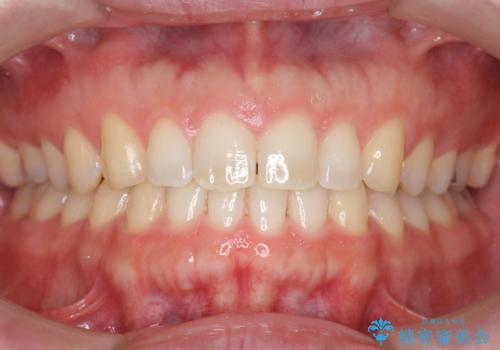 前歯の目立ったすき間 マウスピース矯正で目立たなくしますの治療後