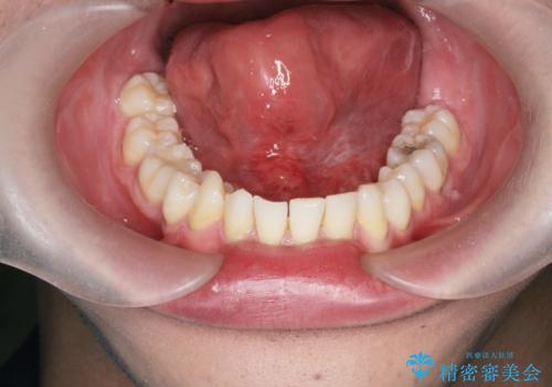 [ 舌小帯形成術 ]舌が短い 小手術での改善の治療後