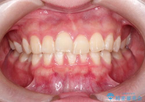 インビザラインで前歯のガタガタをきれいな歯並びへの治療前