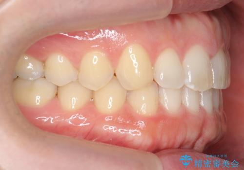 前歯の目立ったすき間 マウスピース矯正で目立たなくしますの治療後