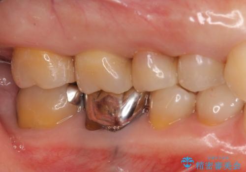 銀歯を白く　虫歯治療の治療後