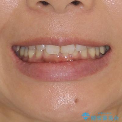 抜歯矯正の後戻りでできたスペース インビザライン矯正とセラミック治療の治療前(顔貌)