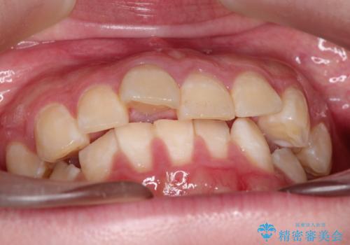 インビザラインで前歯のガタガタをきれいな歯並びへの症例 治療前