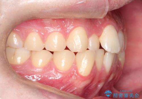 『目立たない装置で前歯のガタガタを治したい』インビザライン症例の治療前