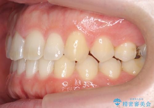 前歯の目立ったすき間 マウスピース矯正で目立たなくしますの治療後