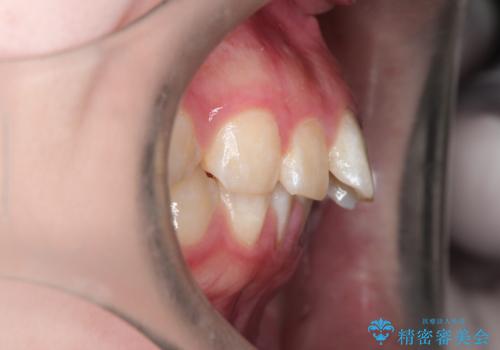 インビザラインで前歯のガタガタをきれいな歯並びへの治療前