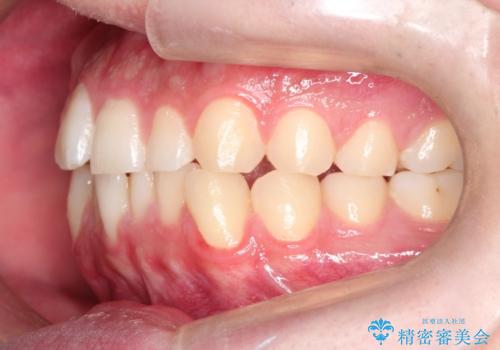 『目立たない装置で前歯のガタガタを治したい』インビザライン症例の治療前