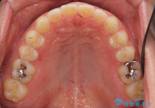 前歯の目立ったすき間 マウスピース矯正で目立たなくしますの治療後