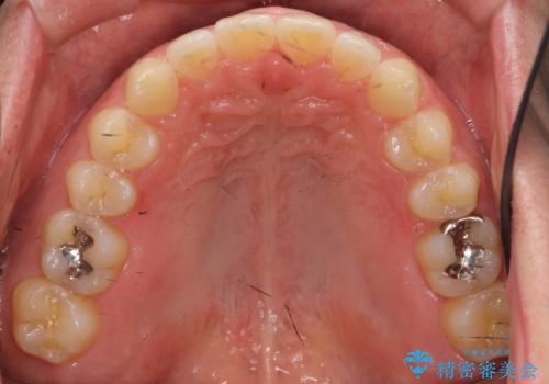 前歯の目立ったすき間　マウスピース矯正で目立たなくしますの治療後