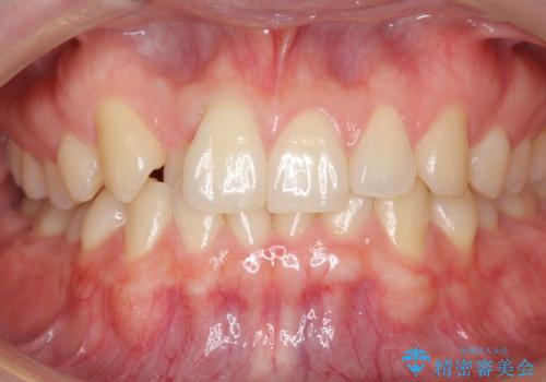 引っ込んだ前歯を並べる　歯を抜かないマウスピース矯正の治療前