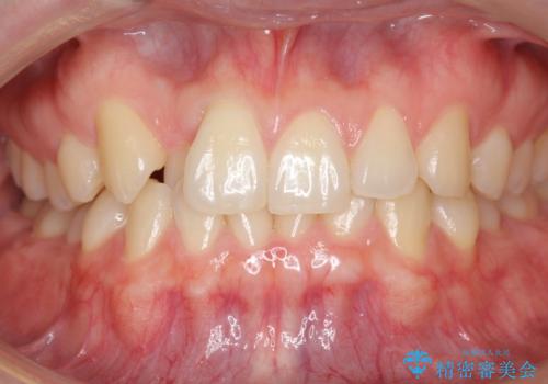 引っ込んだ前歯を並べる　歯を抜かないマウスピース矯正