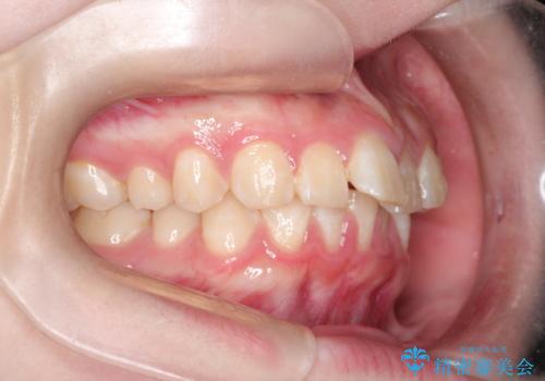 インビザラインで前歯のガタガタをきれいな歯並びへの治療前