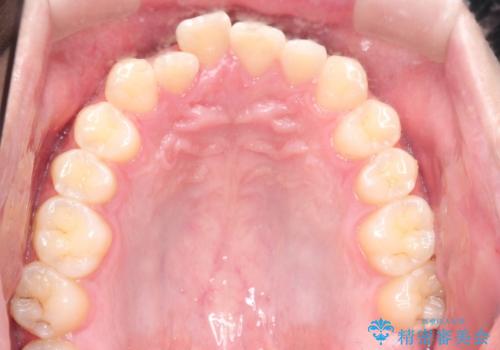 『目立たない装置で前歯のガタガタを治したい』インビザライン症例の治療前