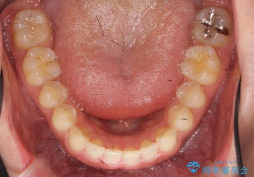前歯の目立ったすき間　マウスピース矯正で目立たなくしますの治療後