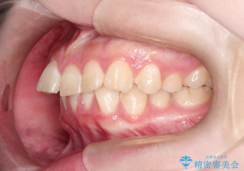 インビザラインで前歯のガタガタをきれいな歯並びへの治療前