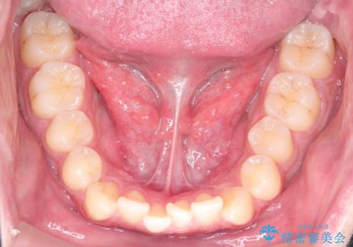 『目立たない装置で前歯のガタガタを治したい』インビザライン症例の治療前