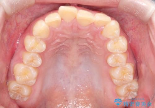 インビザラインで前歯のガタガタをきれいな歯並びへの治療前