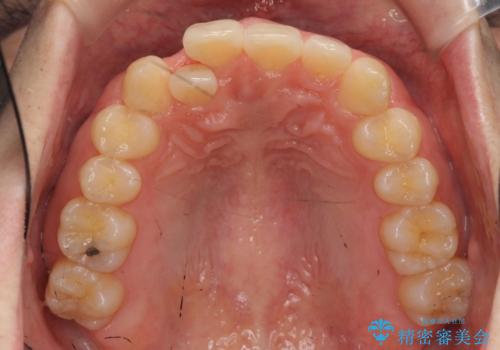 引っ込んだ前歯を並べる　歯を抜かないマウスピース矯正の治療前