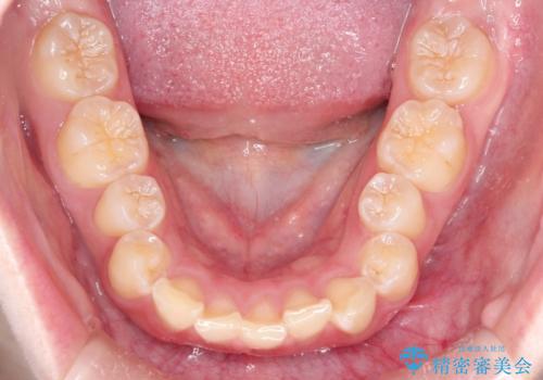 インビザラインで前歯のガタガタをきれいな歯並びへの治療前