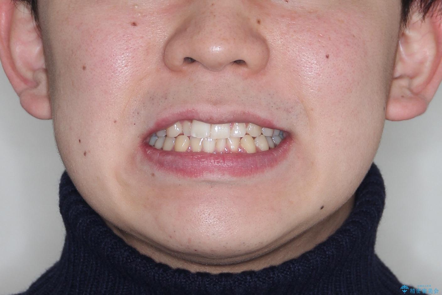 『目立たない装置で前歯のガタガタを治したい』インビザライン症例の治療前（顔貌）