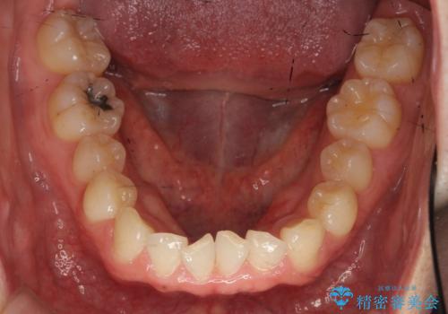 引っ込んだ前歯を並べる　歯を抜かないマウスピース矯正の治療前
