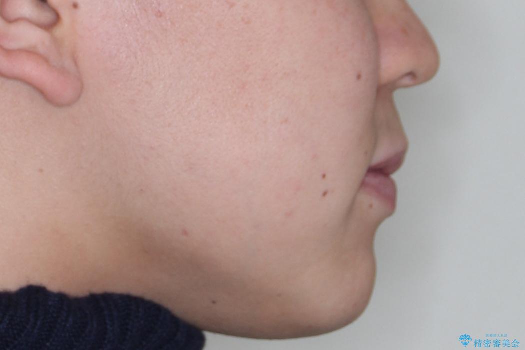 『目立たない装置で前歯のガタガタを治したい』インビザライン症例の治療前(顔貌)